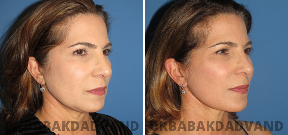 Before and After Photos. Facelift img-5
